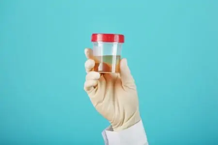 Urine in a cup