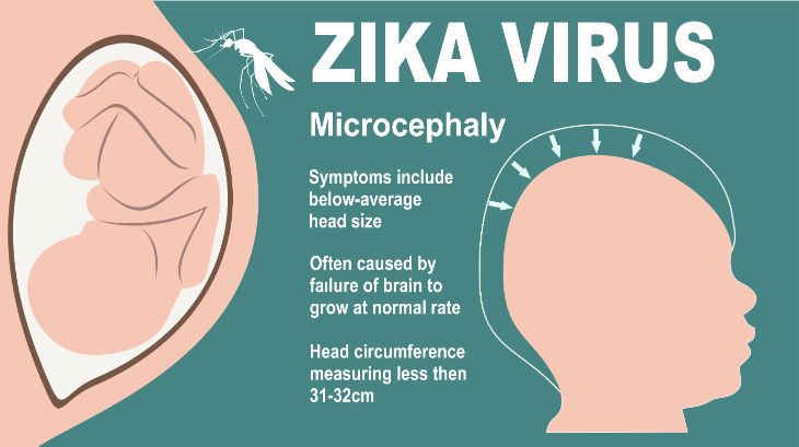 Le virus Zika pendant la grossesse (1)
