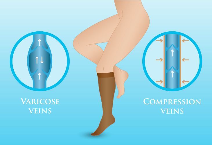 The benefits of compression stockings during pregnancy