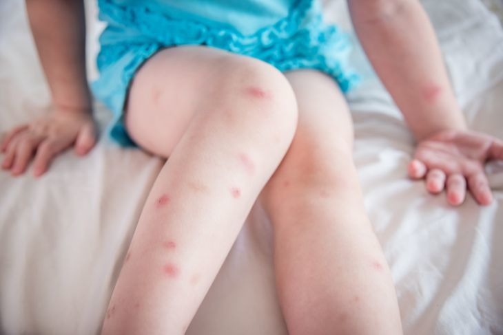 Young girl with mosquito bites on her legs.