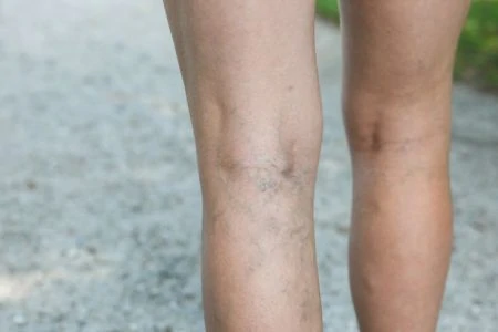 Pregnant woman with varicose veins on her legs