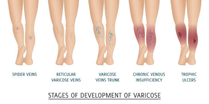 Varicose Veins During Pregnancy: Causes & 5 Tips to Help ...