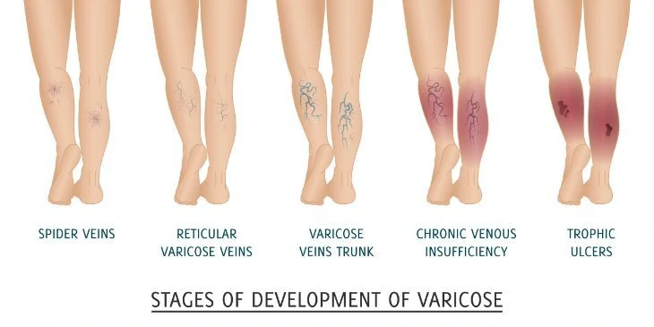 The stages of varicose veins