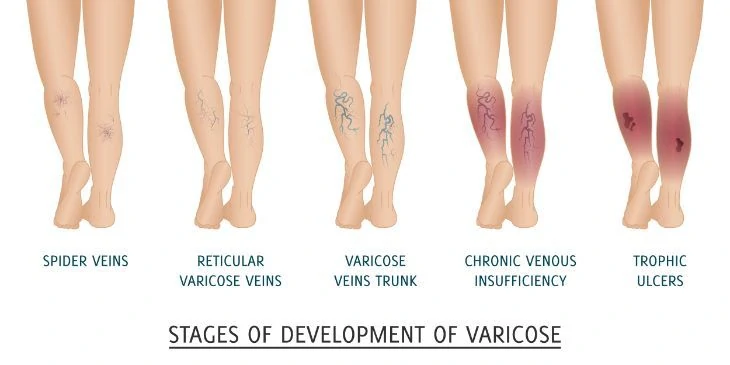 Varicose Veins During Pregnancy: Causes & Tips