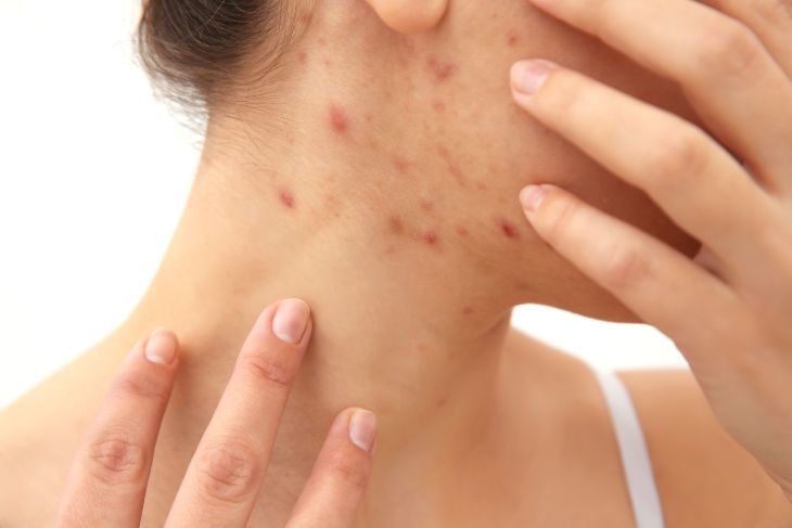 what to do acne during pregnancy