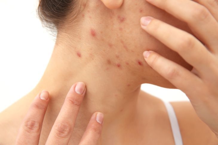 which acne drug is best