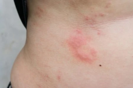 Pregnant woman with a rash on her stomach