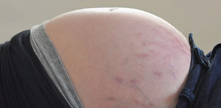 Red and purple stretch marks during pregnancy (1)