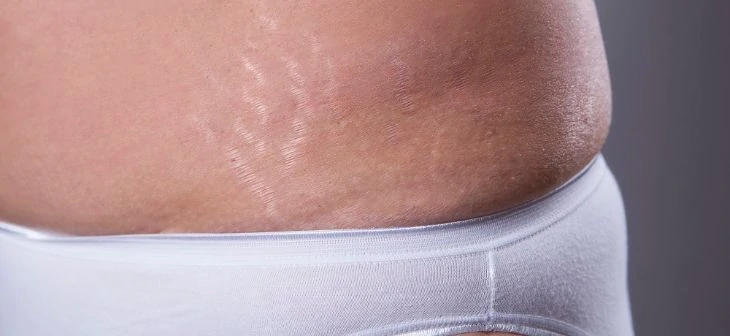 Silver colored stretch marks after pregnancy