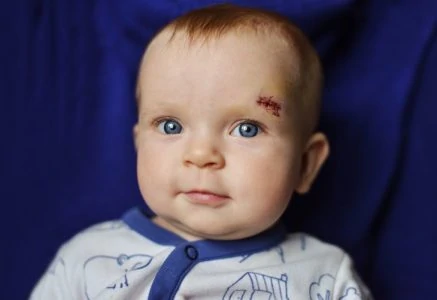 Baby boy with a head injury