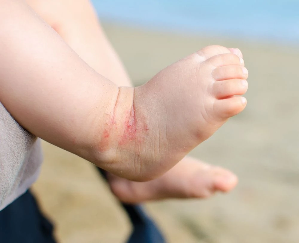 Atopic Eczema on baby's leg
