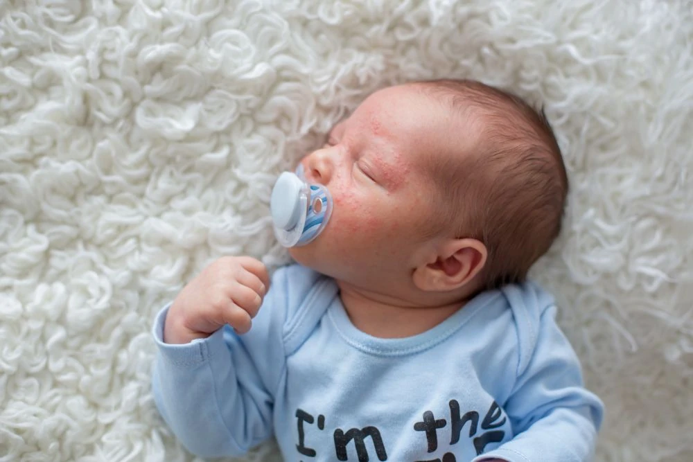 Baby with acne sucking a pacifier