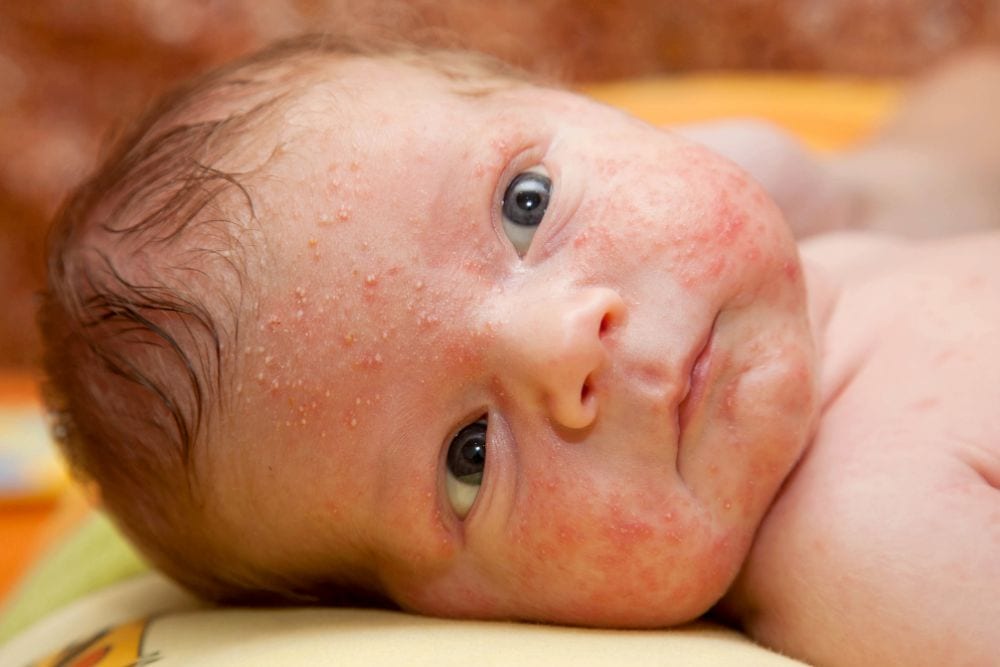 Baby with acne on his skin