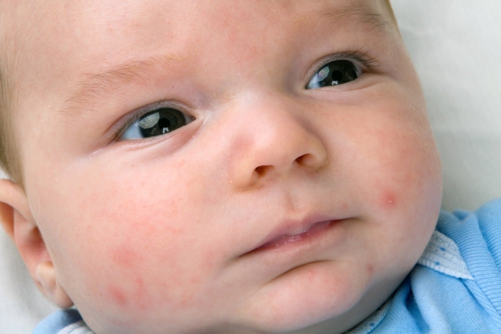 Baby boy with acne