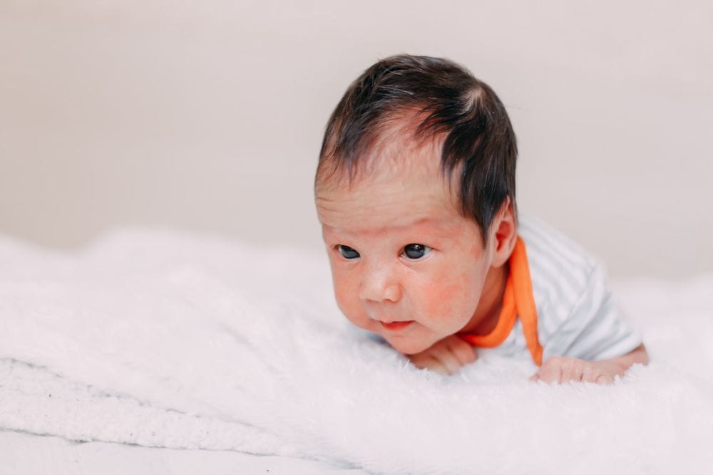 Dark spots on child's back