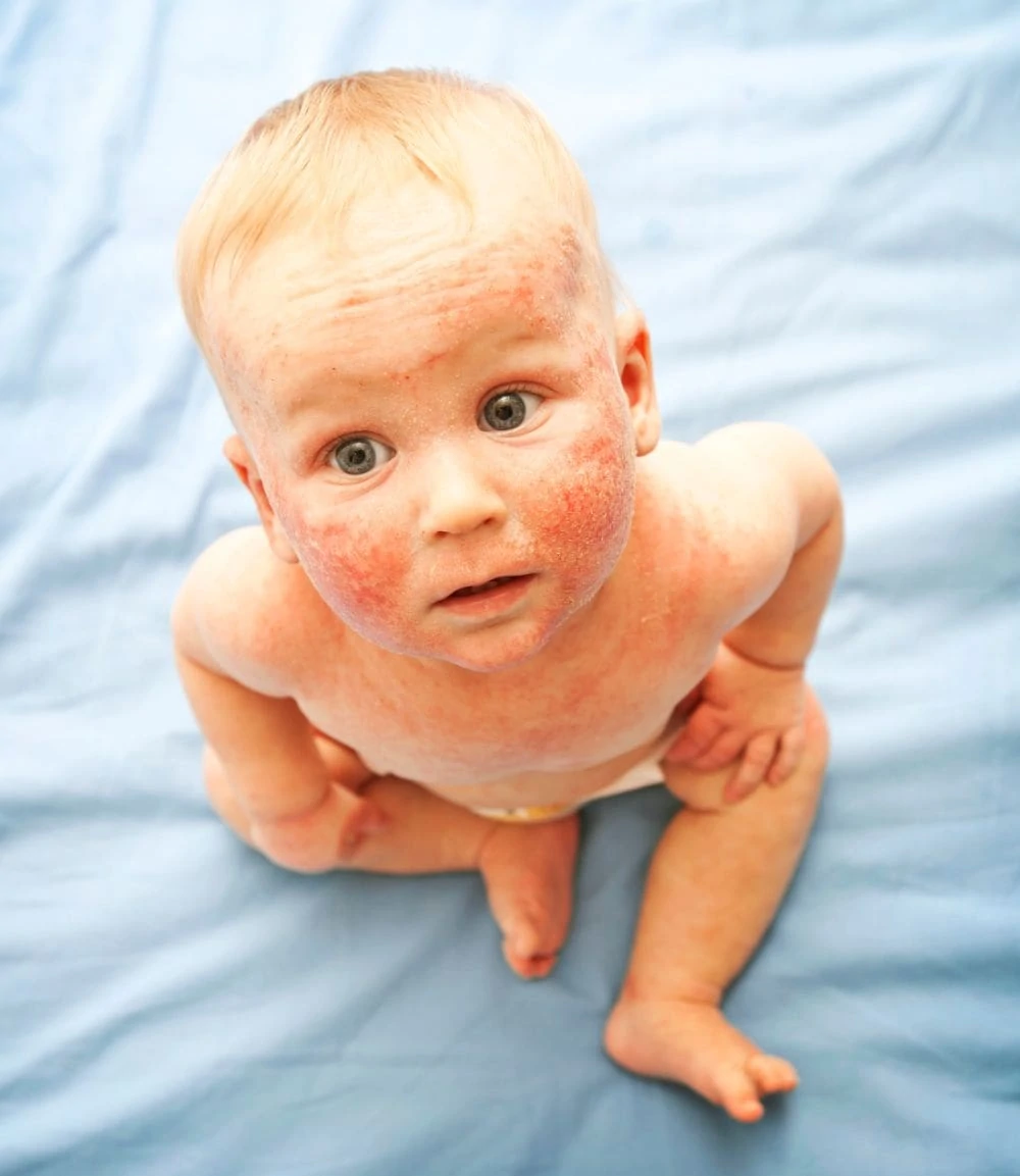 Fifth disease on toddler
