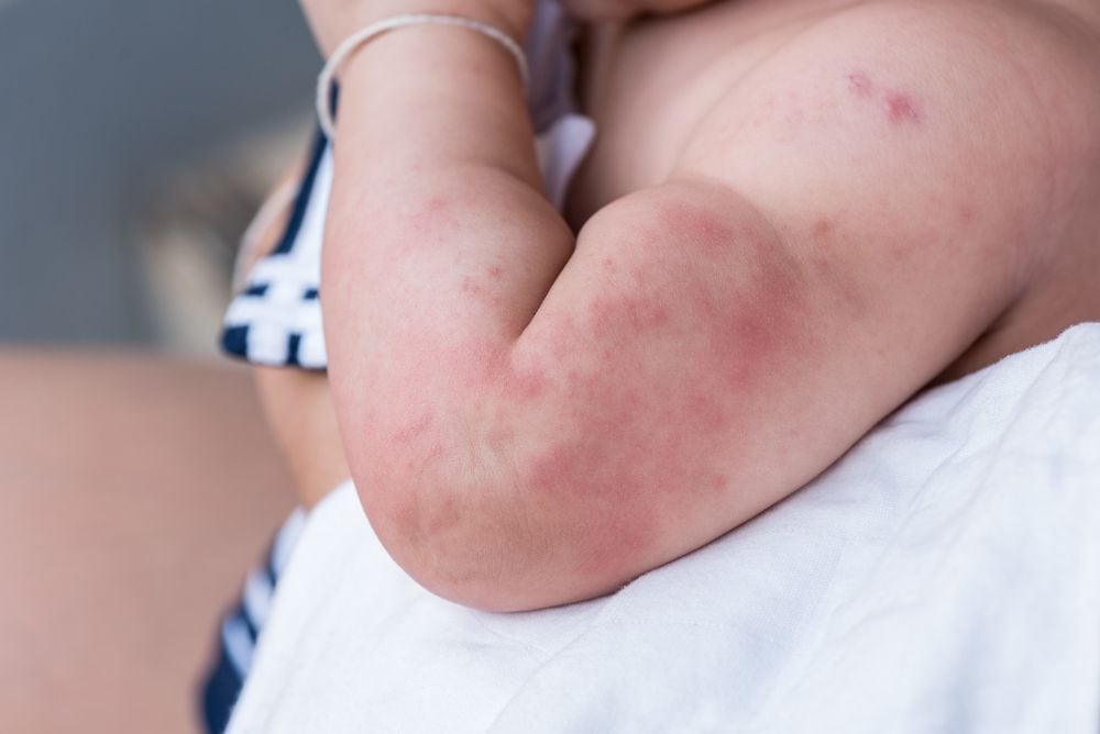 Baby rash on arms and face