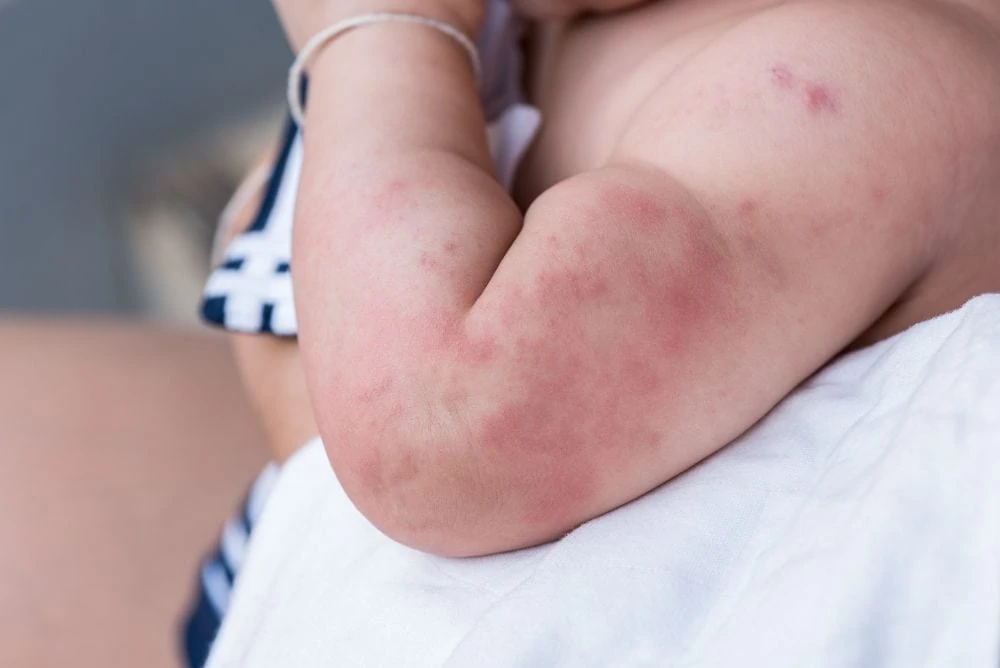 Rash on baby skin