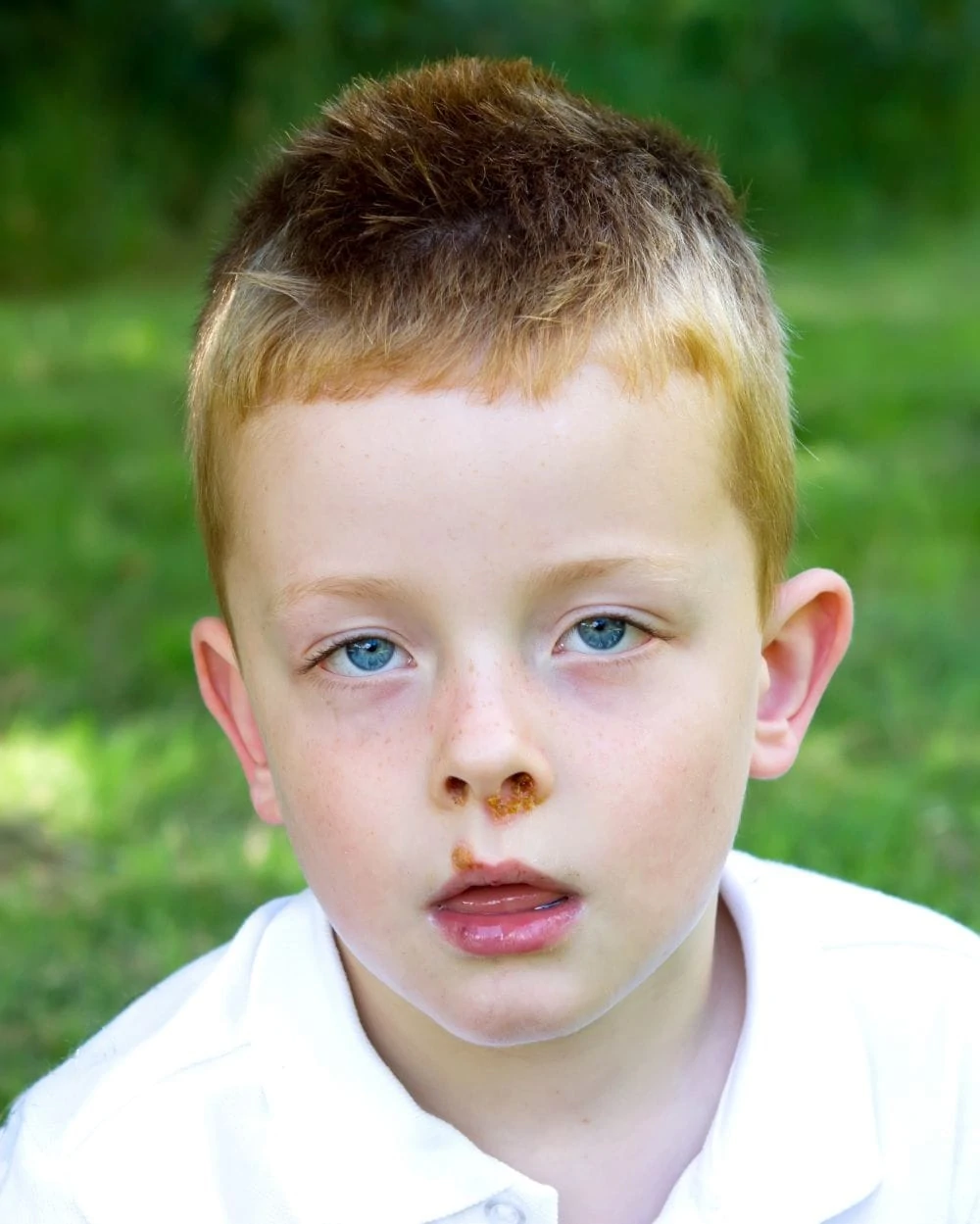 rash under a child's nose