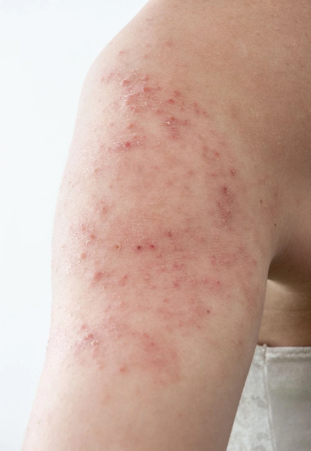 baby dry skin rash