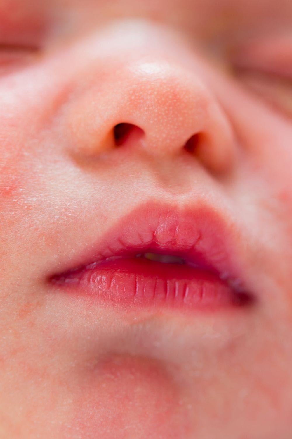 rash on baby's nose