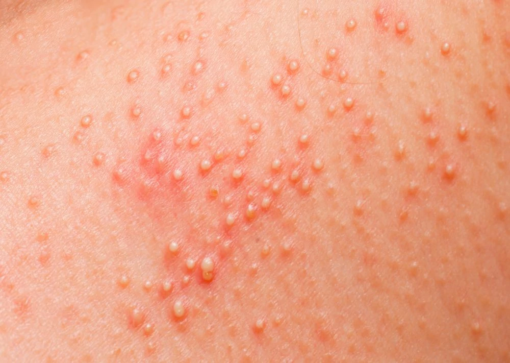 17 Most Common Types of Baby Rashes: With Pictures