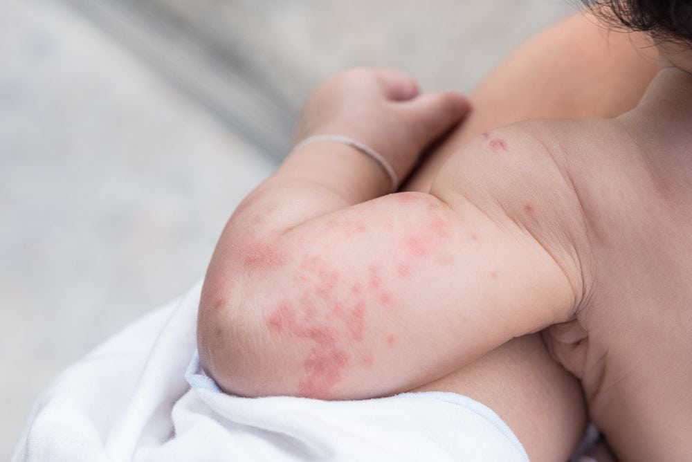Hives on baby skin