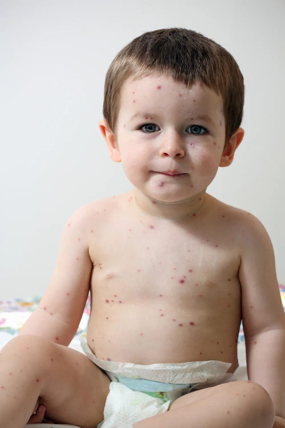 17 Most Common Types of Baby Rashes: With Pictures