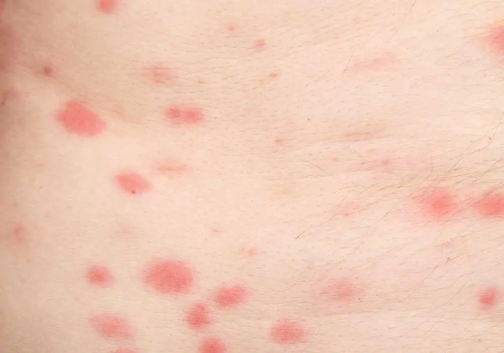 sand flea bites on children