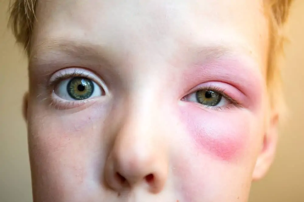 Little boy with big bee sting under the eye