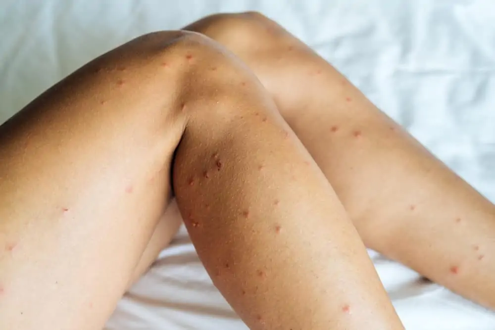Female legs with many sand fly bites