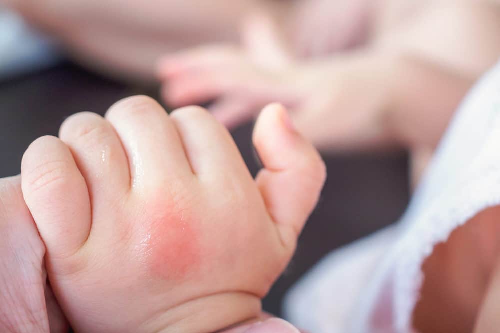 Insect bite on baby's hand