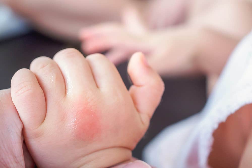 cockroach bite marks on baby