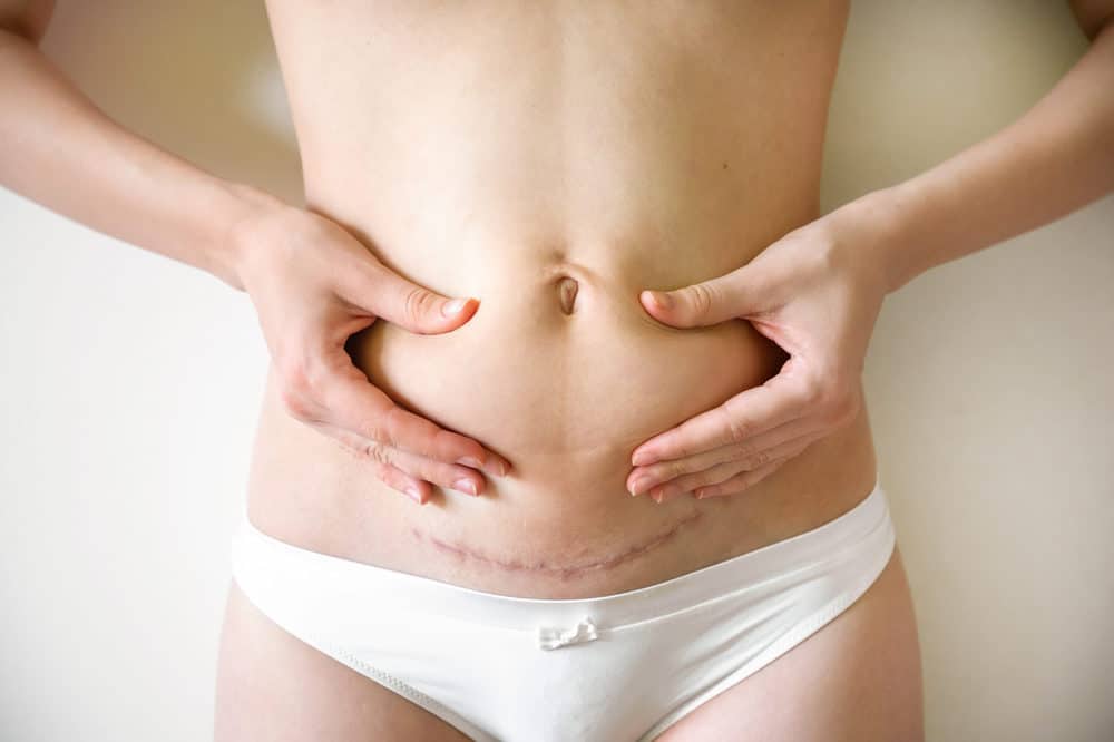 Loose Skin After Pregnancy (What You Can Do About It) - MomL