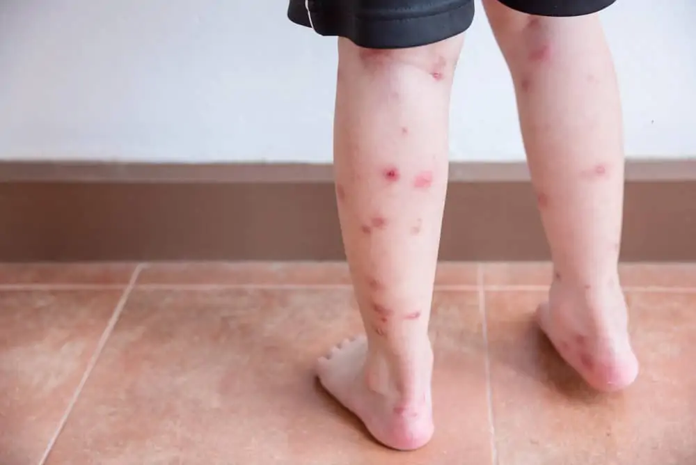 Child's legs with mosquito bites
