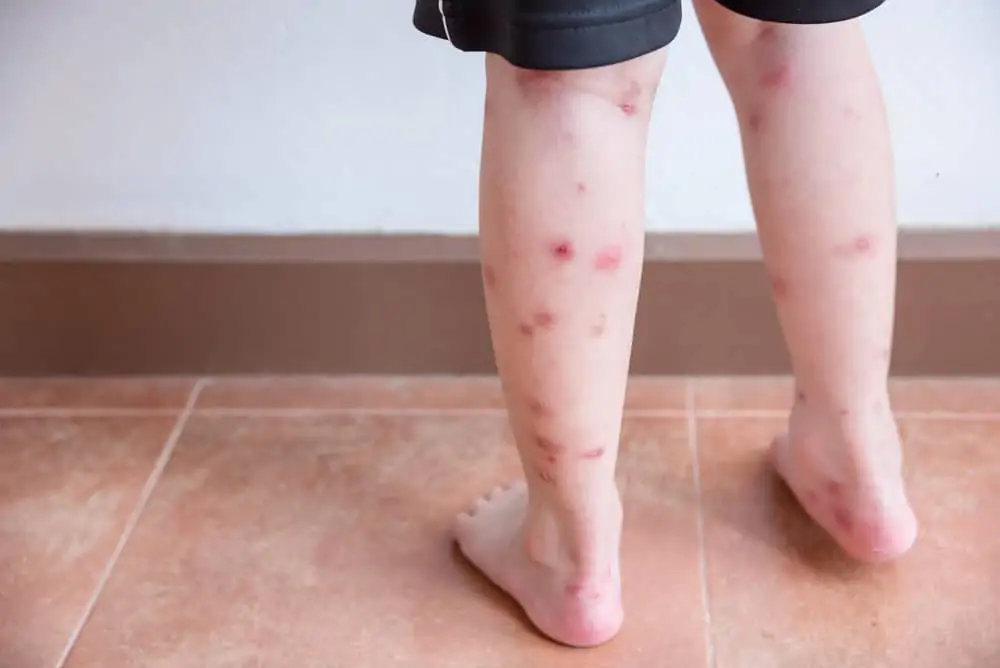 sand flea bites on children