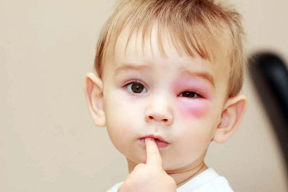 Little boy with wasp sting on the eye
