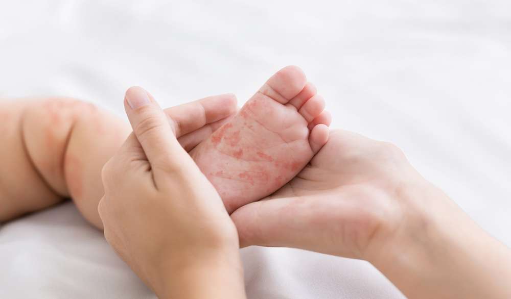 baby measles skin rash